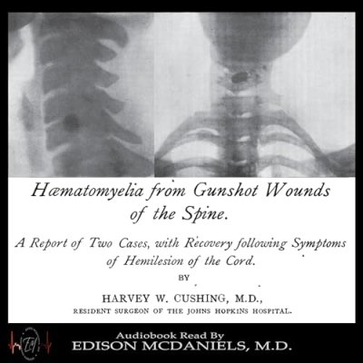 Haematomyelia from Gunshot Wounds of the Spine